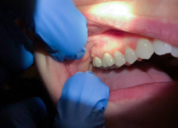 Best Emergency Dental Services for Seniors in Poplar Cotton Center, CA